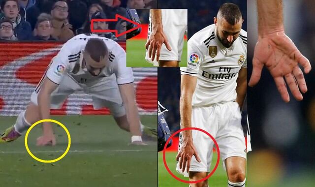 Benzema cae, se rompe dedo y queda doblado: Espeluznante lesión en el Real Madrid vs Betis