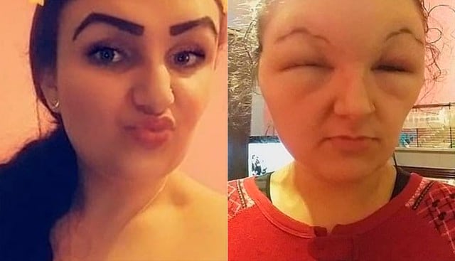 Se tiñó el cabello, pero sufrió grave reacción alérgica y terminó con la cara desfigurada. El caso viral ocurrió en el Reino Unido. (Facebook)