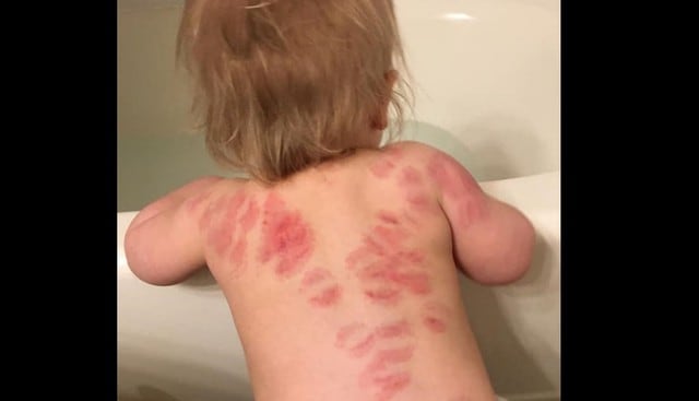 Fue a recoger a su bebé en la guardería y la encontró con más de 25 mordeduras en la espalda. (Fotos: Facebook)