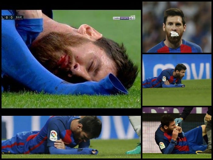 Lionel Messi sangrante, tras recibir codazo de Marcelo, que le reventó la boca
