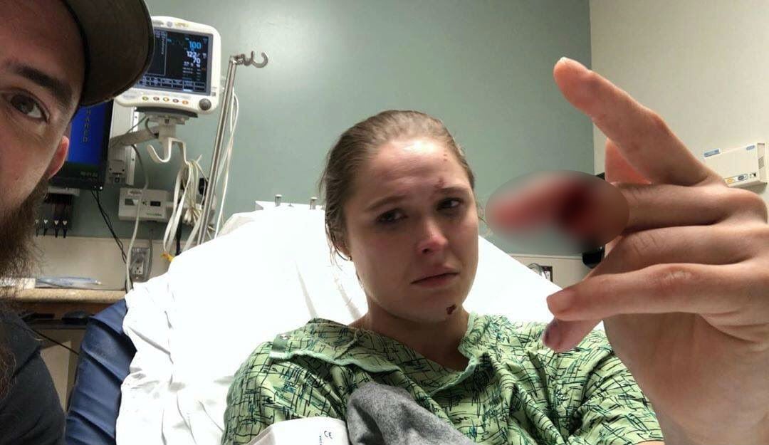 Ronda casi pierde un dedo en accidente. (Instagram Ronda Rousey)