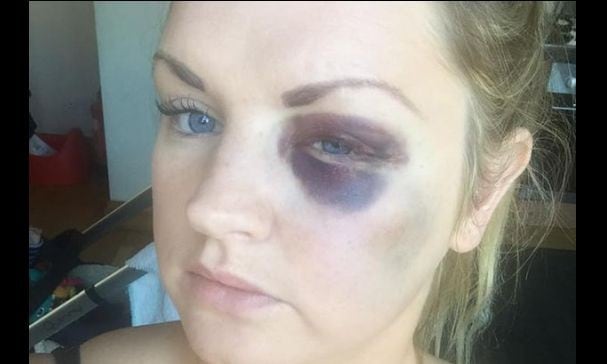 En Facebook, la foto de una chica con el ojo morado se volvió viral. Entérate el motivo. (Manchester Evening News Syndication)