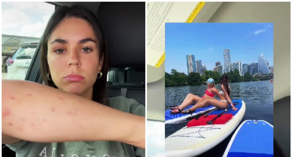 Viral TikTok Las Consecuencias Que Le Provocaron Un Lago Contaminado Al Cuerpo De Una Joven