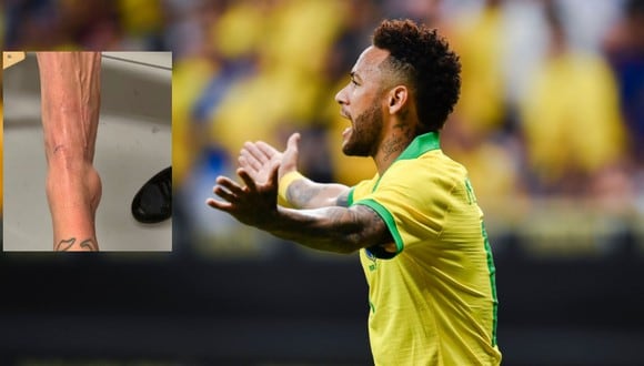 Neymar: La escalofriante deformación de su tobillo impacta al mundo entero | Foto viral