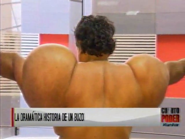 Buzo peruano ha quedado con el cuerpo deformado debido al nitrógeno que se ha adherido a sus músculos. (Captura de Video)