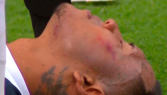 La peligrosa lesión de Bryan Reyna en el Universitario vs. Alianza Lima | VIDEO