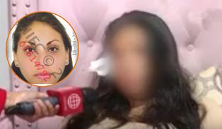 San Juan de Miraflores: joven quedó desfigurada tras ser atacada por la expareja de su novio