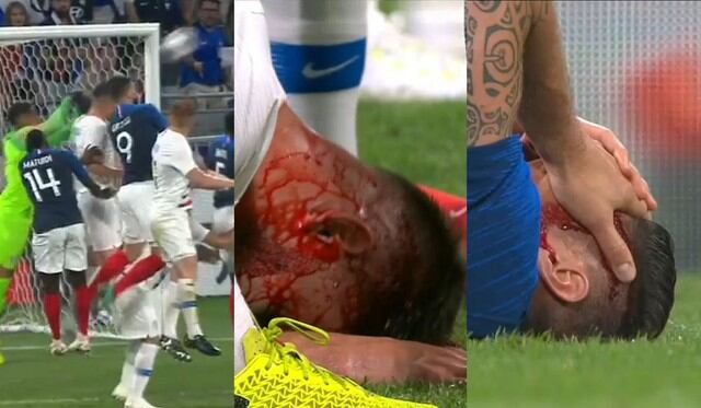 Francia: Giroud y rival se rompieron la cabeza, tras brutal choque que los dejó sangrantes y aterró al mundo