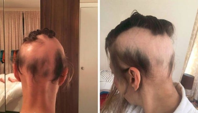 Michelle Wilson-Stimson ha aprendido a vivir con su condición de alopecia. (Fotos: The Sun)