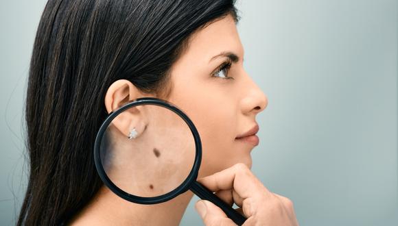 Conoces la regla del ABCDE de los lunares que ayuda a detectar un cáncer de  piel? | melanoma | verano | FAMILIA | TROME.COM