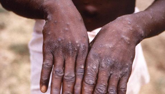 Una imagen tomada durante una investigación sobre un brote de viruela del mono que tuvo lugar en la República Democrática del Congo de 1996 a 1997, muestra las manos de un paciente de dicha enfermedad. (CDC/Brian WJ Mahy/Folleto vía REUTERS).