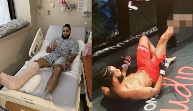 Jonathan King sufrió una de las lesiones más horrendas en la historia del MMA. (Redes sociales)