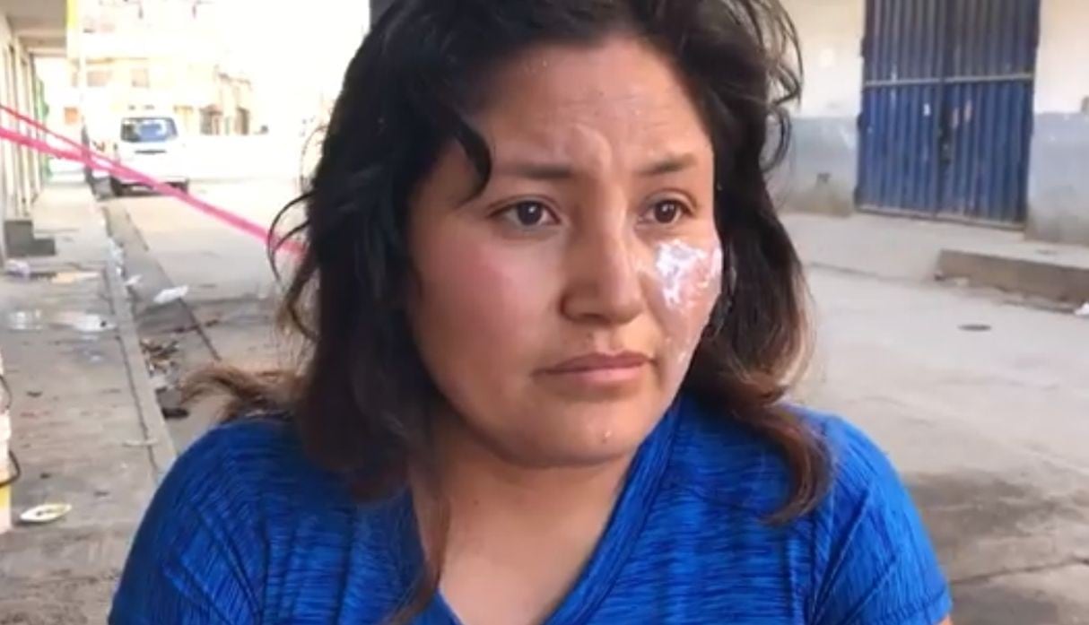 Mujer y niño testigos del ataque a Juana Mendoza resultaron con quemaduras en rostro y cuerpo