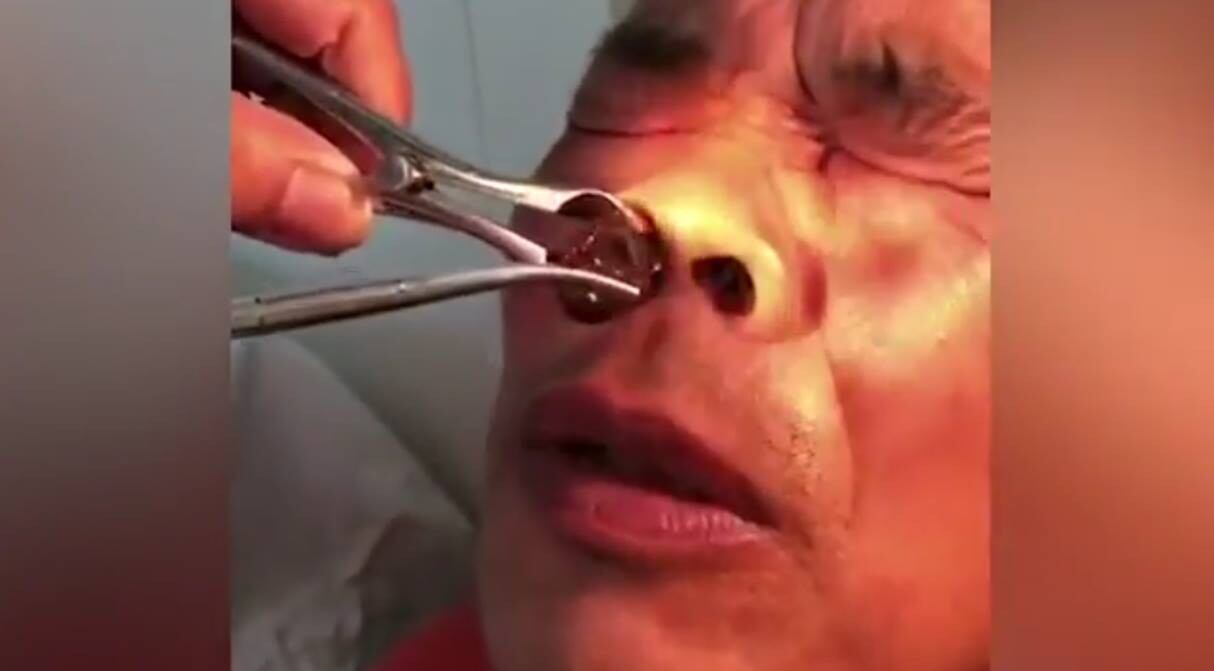 Sacaron una sanguijuela gigante de la nariz de un hombre. (Capturas: YouTube)