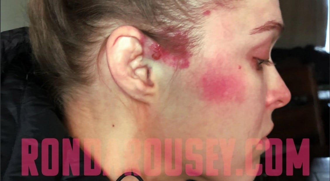 Así terminó el rostro de Ronda Rousey tras ataque de Charlotte. (Foto: Ronda Rousey.com)