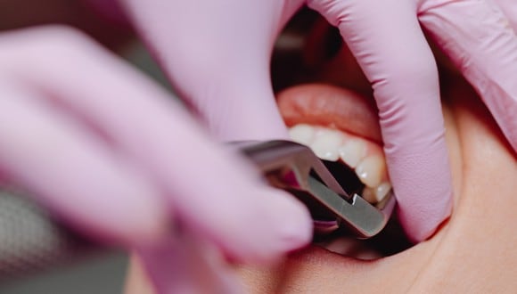 Visitar periódicamente al odontólogo. Nos ayudará a conocer el estado de nuestra salud bucodental, descartando posibles caries y previniendo una probable pérdida ósea. (Foto: Pexel)