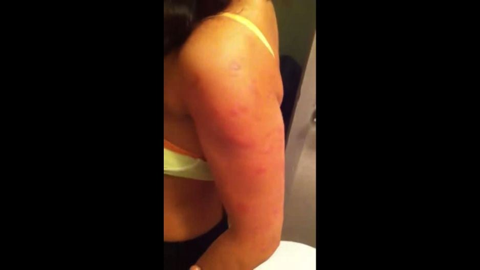 En YouTube se puede ver cómo quedó el brazo de una chica tras dormir en una cama llena de chinches. (Captura)