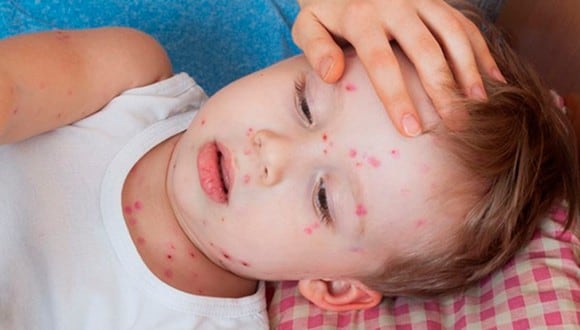 Se recomienda el administrar la primera dosis de la vacuna contra la varicela a niños entre los 12 y los 15 meses de edad, y la segunda entre los 4 y 6 años.