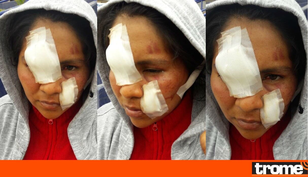 Un desquiciado le cortó la cara a la mamá de su hijo porque ella no quiso volver con él. (Fotos: Trome)