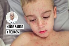 ¿Sabías que el sarampión puede causar complicaciones mortales en niños?