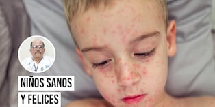 Las complicaciones del sarampión pueden ser tan graves que incluso pueden causar la muerte. Foto: Istock.