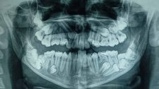Hospital del Niño: Retiran 16 dientes que tenía de más campeona de karate