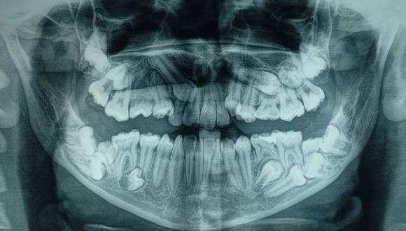 Hospital del Niño: Retiran 16 dientes que tenia de más campeona de karate.