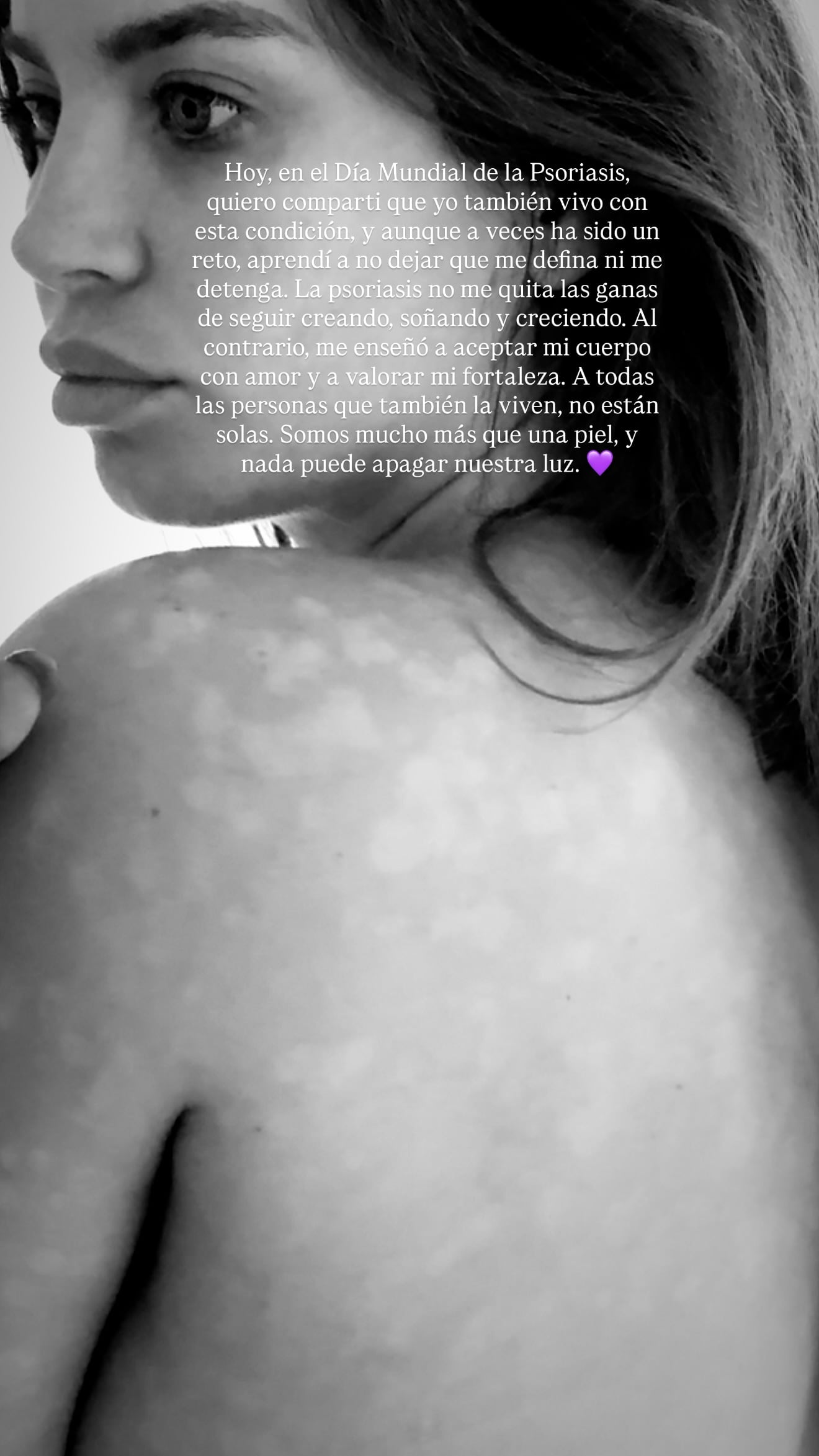 Actriz comparte imágenes de su psoriasis. (Instagram: @flavialaosu)