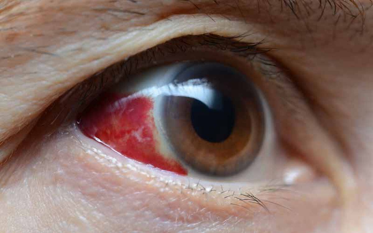 A través de segregaciones lacrimales también se puede transmitir (Foto: infomed.com)