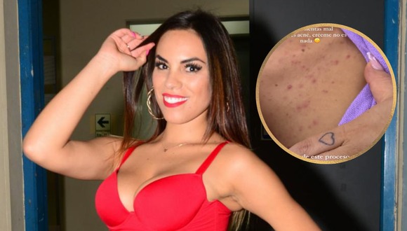 TROME - Aída Martínez revela nuevas secuelas de su enfermedad: “Así tengo todo el cuerpo, duele y arde”