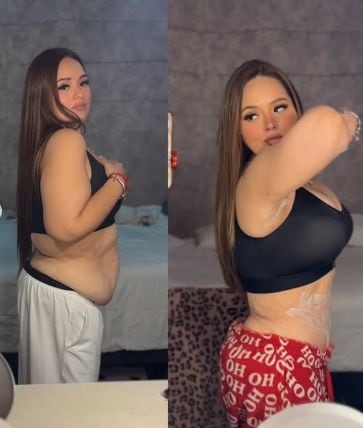 Susan Pietro antes y después de su cirugía reconstructiva