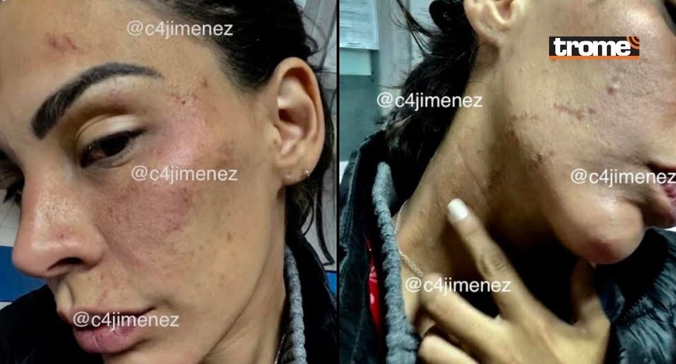 Stephanie Valenzuela dejó ver su rostro con moretones y hasta mordidas que el actor le habría hecho en una de sus mejillas
