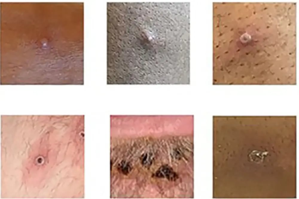 Pacientes con viruela del mono presentaron este tipo de sarpullido en la piel después de los síntomas mencionados. (Foto: AFP)