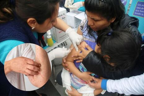 ¡Atención! Casos de sarampión se quintuplican tras primer trimestre del 2025