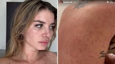 Flavia Laos revela que padece psoriasis y comparte su experiencia