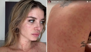 Flavia Laos revela que padece psoriasis y comparte su experiencia