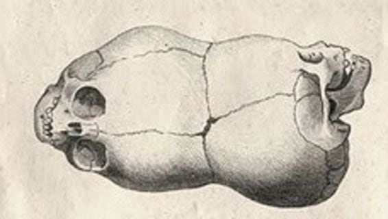 Los casos de craniopagus son extremadamente raros.