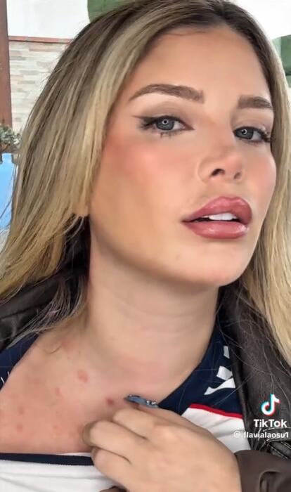 Flavia Laos muestra los efectos de padecer soriasis guttata, una enfermedad autoinmune.