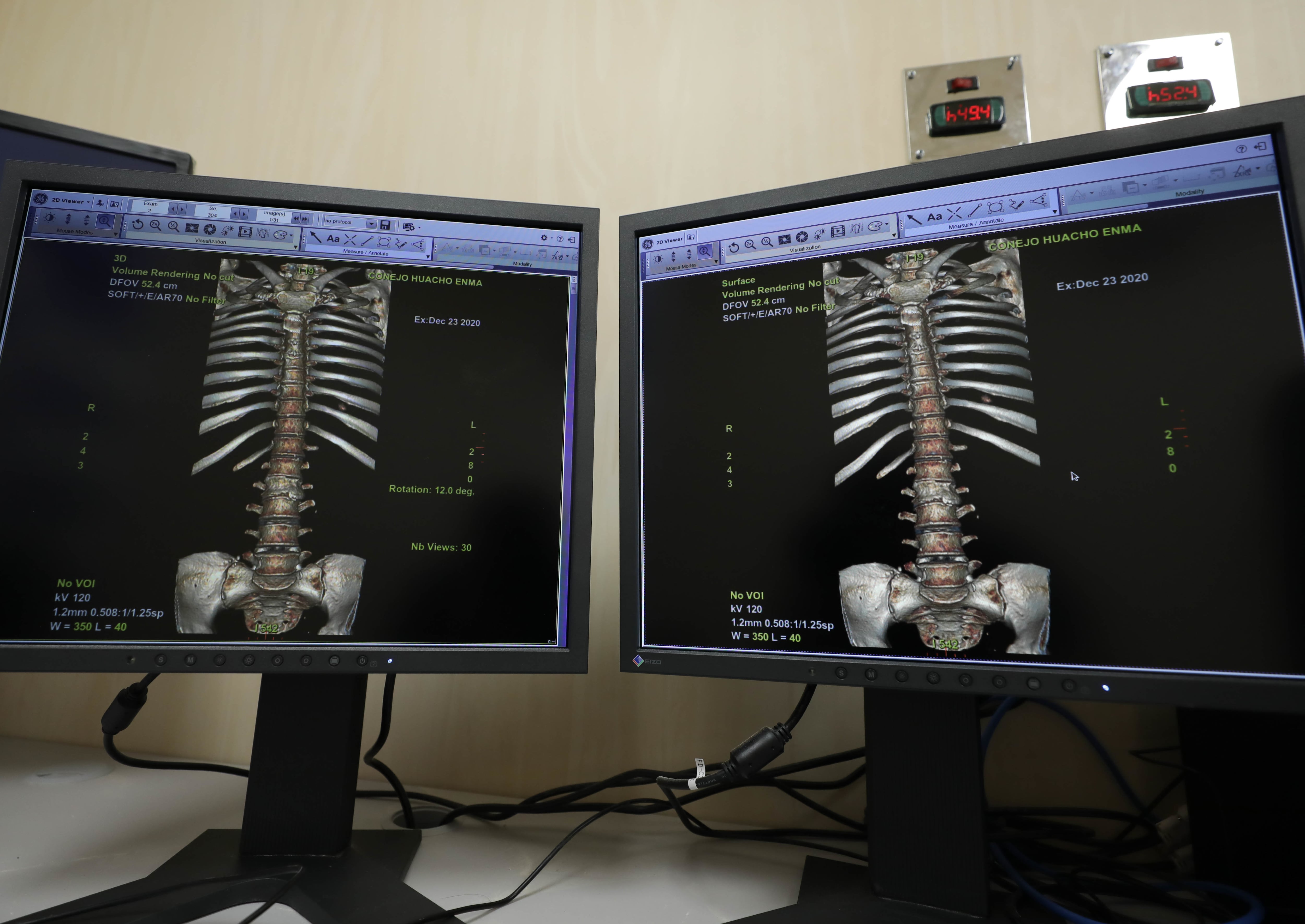 Tomógrafo de 256 cortes emitiendo imágenes en 3D en menos de dos minutos (Foto: EsSalud)