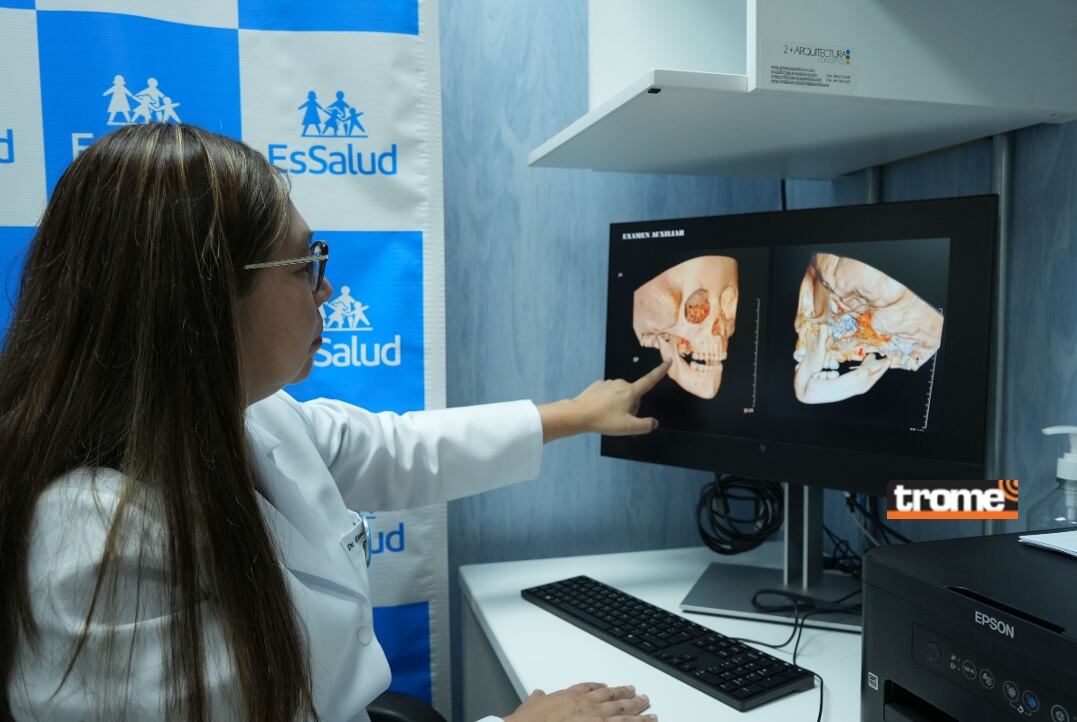 Con tomografía computarizada un equipo de especialistas del hospital Almenara de EsSalud ubicó exactamente dónde estaba la aguja incrustada y la retiraron.. (EsSalud / Isabel Medina / Trome).