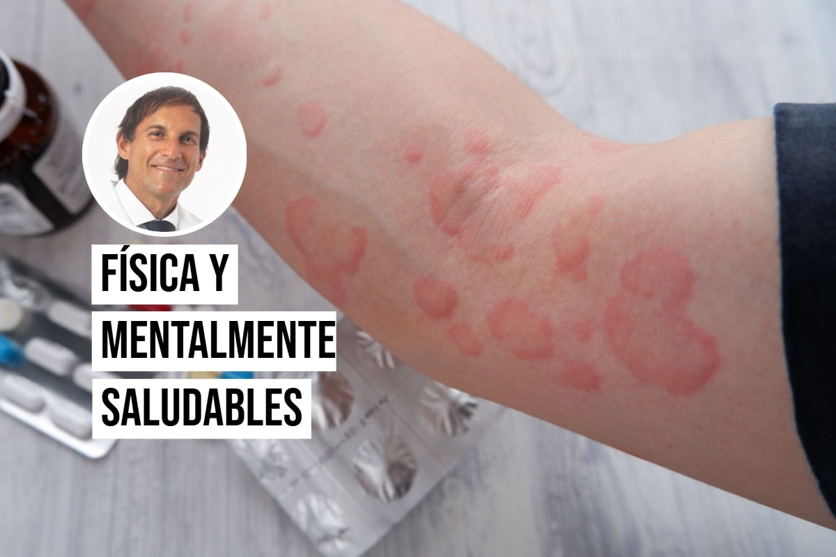 Osores Bianchi explica cómo identificar un cuadro alérgico generalizado y qué hacer de inmediato. Foto: Istock.