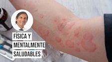 Cuadro alérgico generalizado: qué es, cuáles son sus síntomas, causas y tratamiento