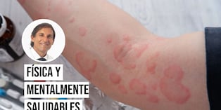 Osores Bianchi explica cómo identificar un cuadro alérgico generalizado y qué hacer de inmediato. Foto: Istock.