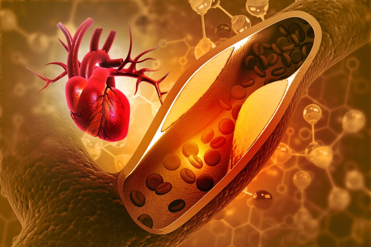 Corazón con artería obstruida por triglicéridos altos. Foto: Istock.
