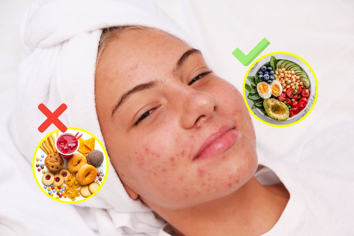 El nutriólogo Gerardo Bouroncle afirma que los brotes de acné pueden evitarse con una alimentación más saludable. Foto: Istock.