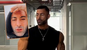 Sebastián Lizarzaburu con cicatrices en el rostro ¿Qué le pasó? : “He pasado por días medios complícados”