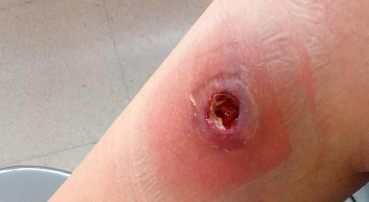 La picadura de la 'araña de rincón' causa enrojecimiento e inflamación, evolucionando a una lesión necrótica con centro oscuro/azulado.