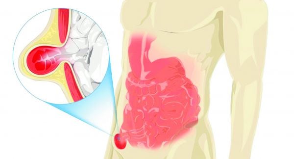 La hernia inguinal no desaparece por sí sola. Aunque en algunos casos puede vigilarse si es pequeña y no causa síntomas, el único tratamiento definitivo es la cirugía. Foto: difusión