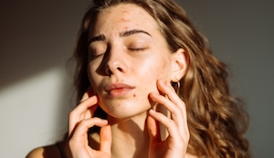 Si ya estoy mayor, ¿por qué me salen barritos?