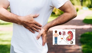 Piedras en los riñones: ¿Cuáles son las causas y cómo lo puedes evitar?